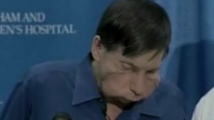   Segundo trasplantado de cara en EE.UU. se presentó ante la prensa 