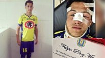U. de Concepción premió a juvenil que se fracturó por trancar con la cabeza