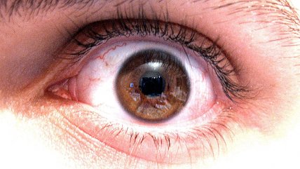   Descubren el patrón genético de la manía, clave para dar con nuevos tratamientos 